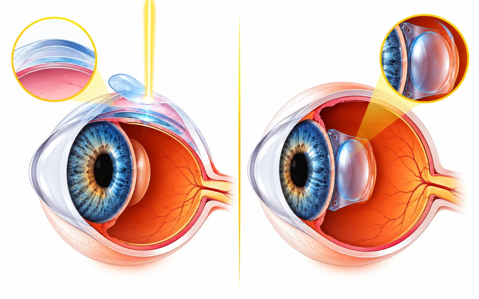 LASIK vs ICL in Delhi: Best Choice for Thin Cornea, High Power
