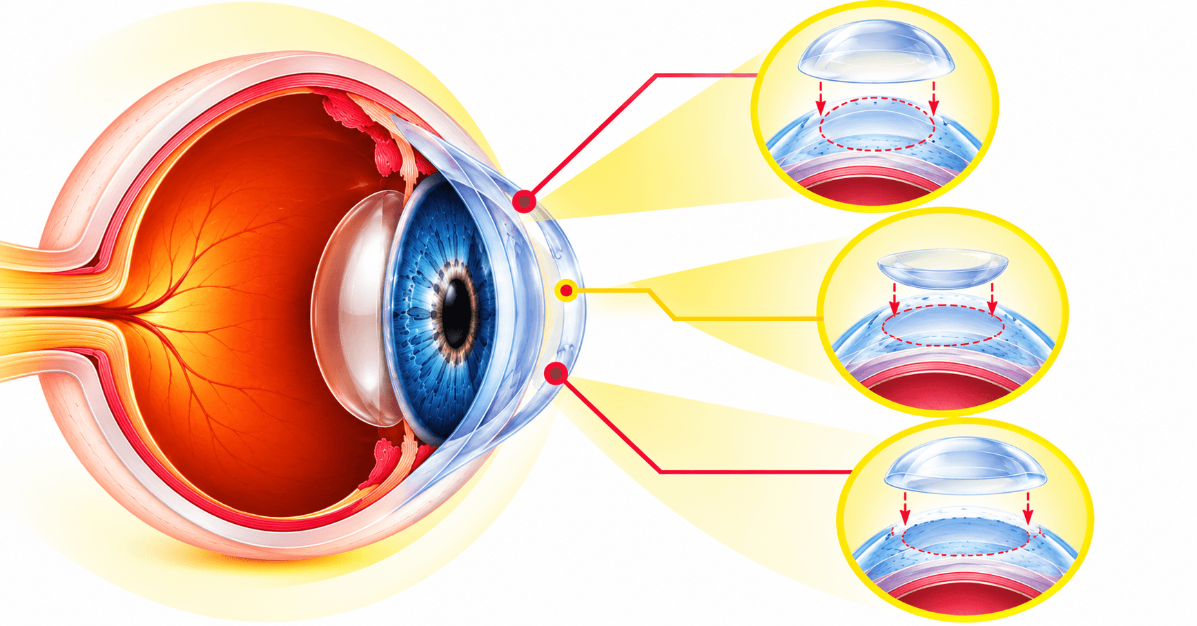 Cornea Transplant in Delhi: PKP vs DSAEK vs DALK Explained